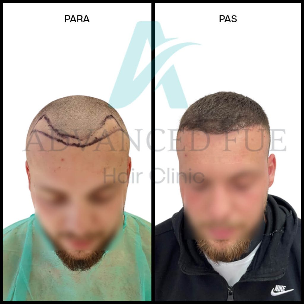 Results before & after Hair Transplant in Albania, Tirana