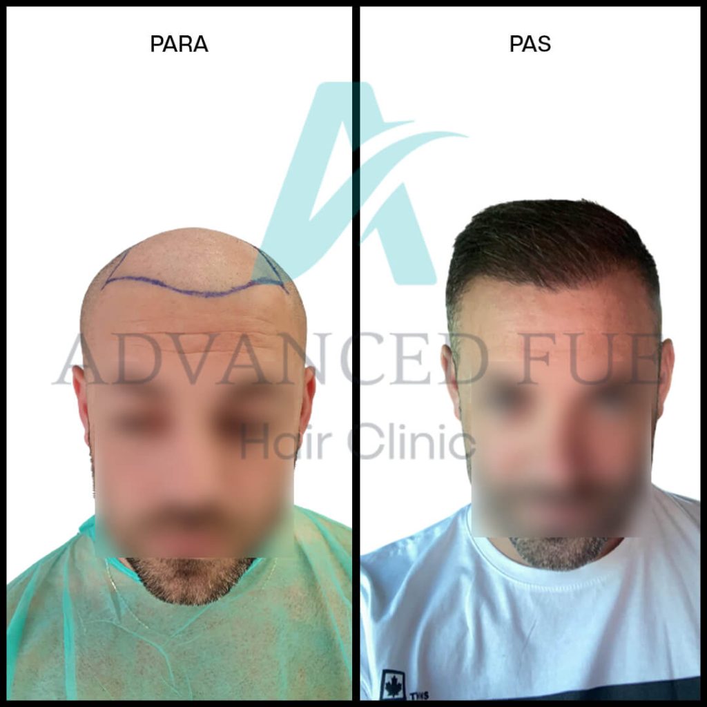 Results before & after Hair Transplant in Albania, Tirana