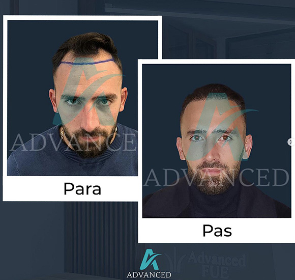Healing after hair transplant