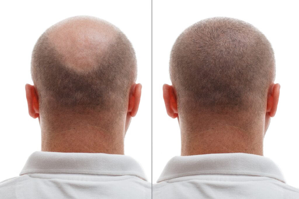head balding man before after hair transplant surgery man losing his hair has become 1 min