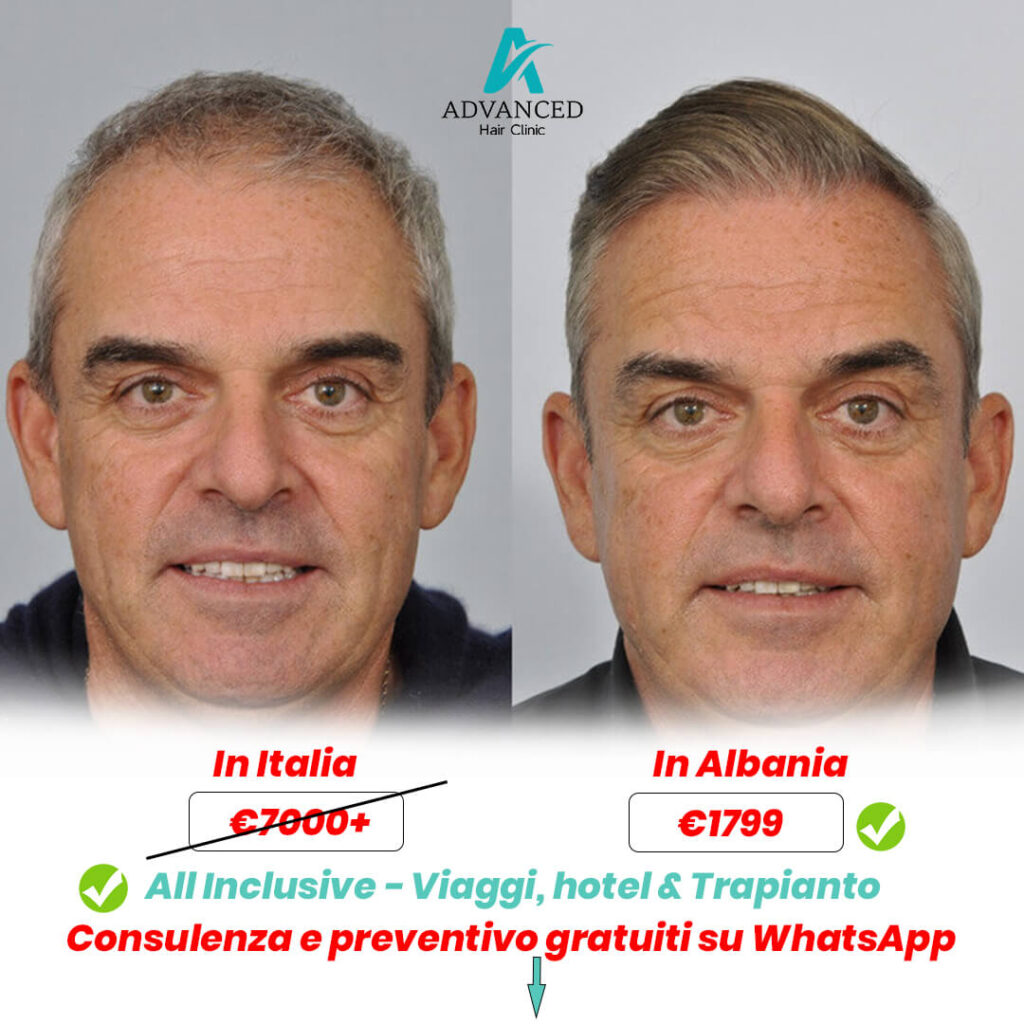 Risultati del trapianto di capelli in Albania di un paziente maschio dall'Italia prima e dopo.