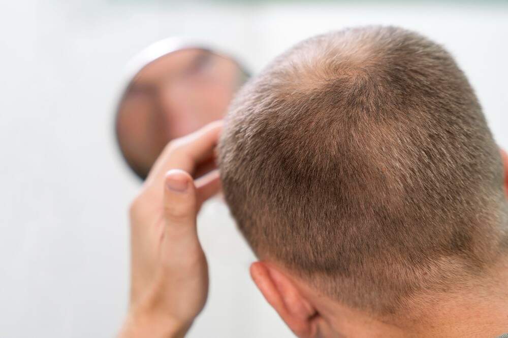 Photo illustrating hair loss in men