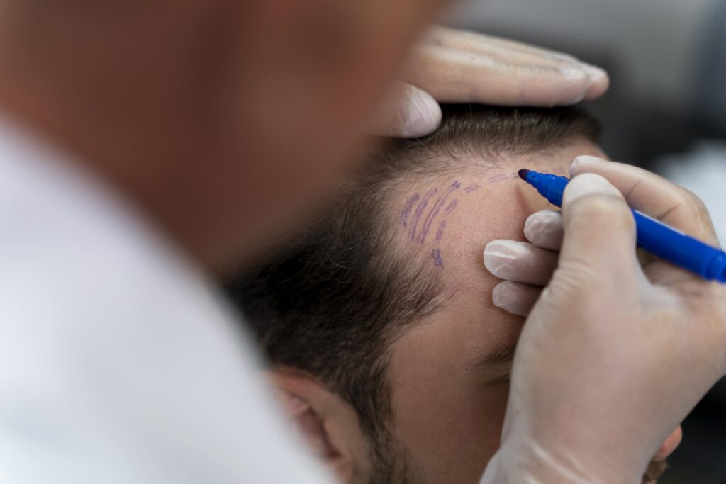 Photo illustrating a consultation with the doctor for a hair transplant.