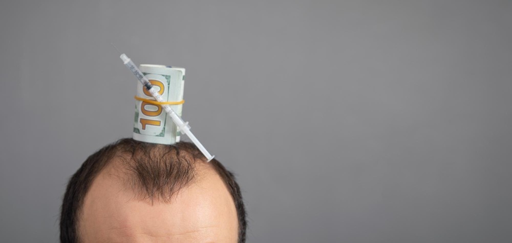 Foto che illustra il costo del trapianto di capelli in Albania