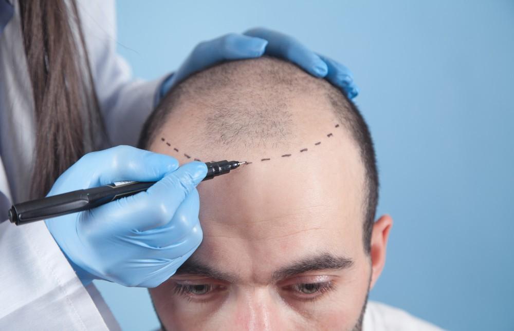 Foto che illustra la procedura di trapianto di capelli in Albania.