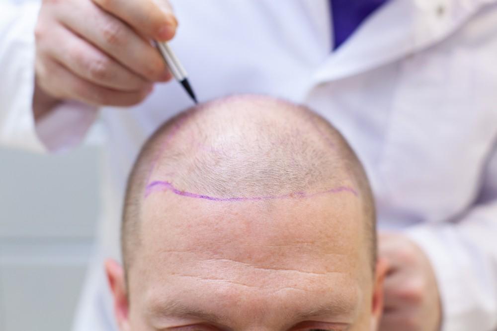 Photo illustrating the preparation for a hair transplantation with the FUE technique in Albania